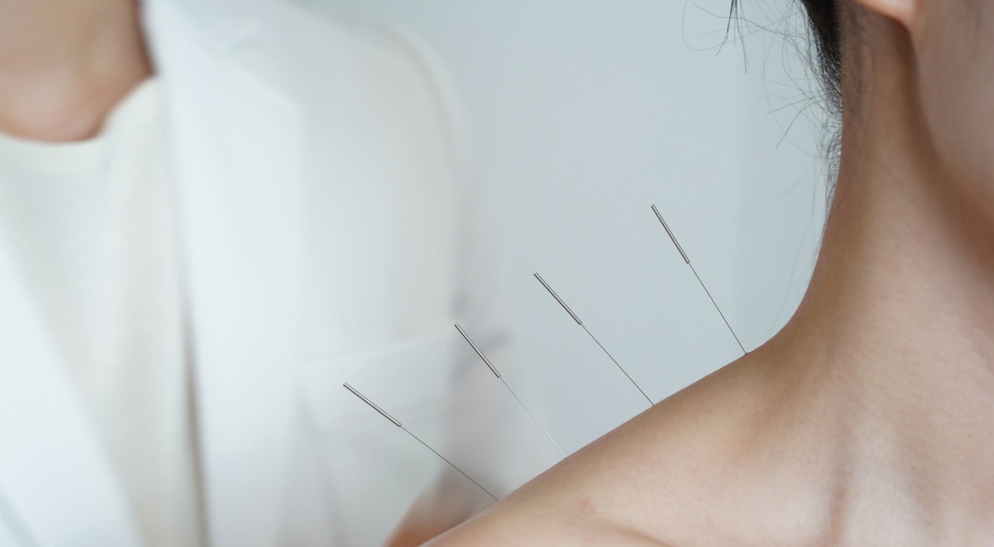 Daisy Freedman Acupuncture, traditional acupuncture in the Forest of Dean, chronic pain, emotional health, womens wellbeing, fire cupping, help with digestive issues, facial enhancement acupuncture